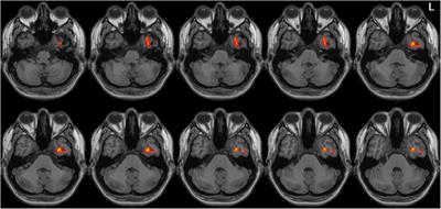 Abnormal Spontaneous Brain Activity in Left-Onset Parkinson Disease: A Resting-State Functional MRI Study